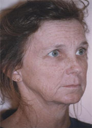 Ensenada Plastic Surgeons-Restiramiento Facial