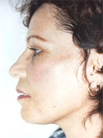 Ensenada Plastic Surgeons-Restiramiento Facial